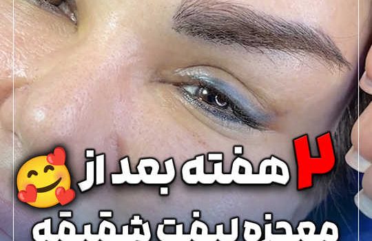دو هفته بعد از معجزه لیفت شقیقه