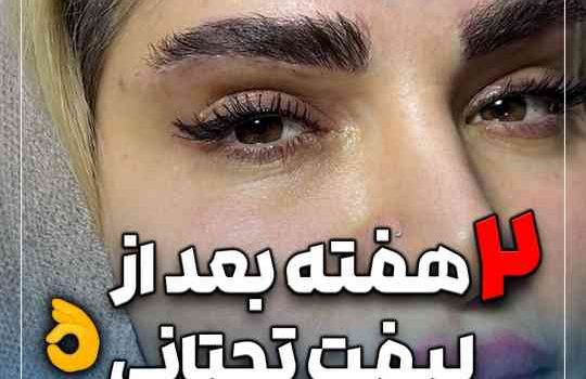 2هفته بعد از لیفت تحتانی