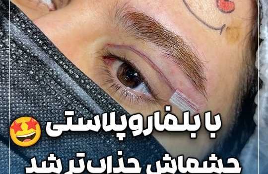 با بلفاروپلاستی چشماش جذاب تر شد