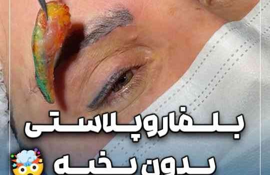 بلفاروپلاستی بدون بخیه