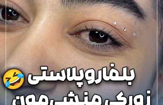 جراحی بلفاروپلاستی منشیمون