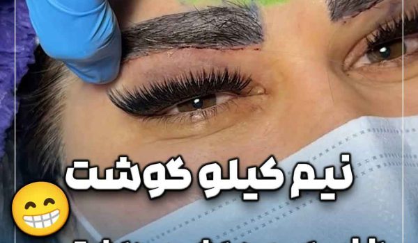 حذف پف زیر ابرو با بخیه لیزری