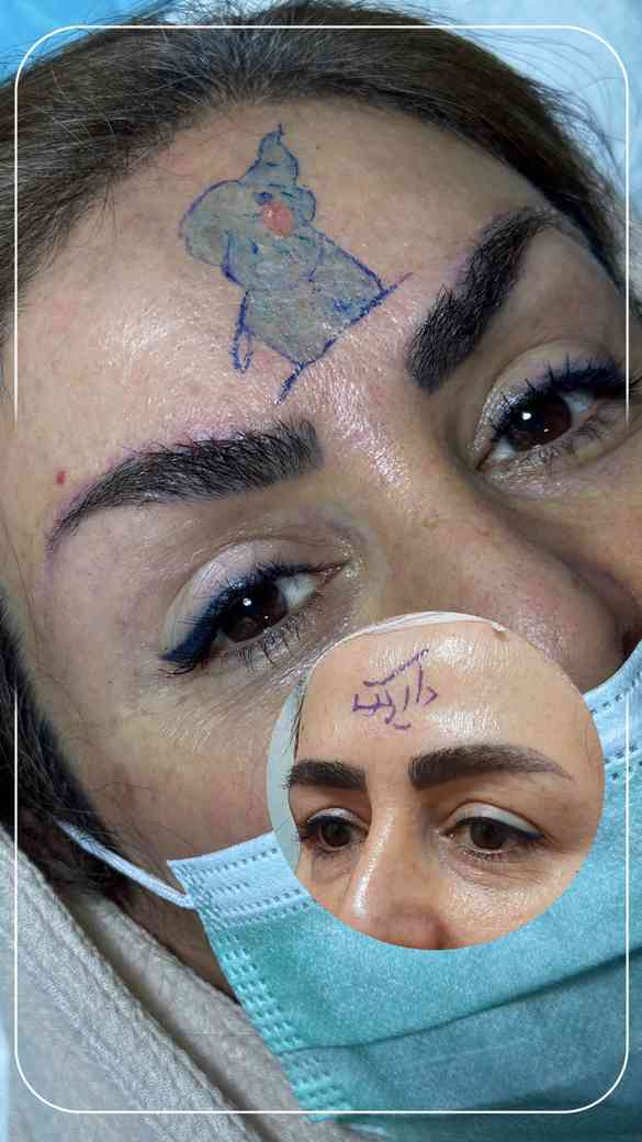 دو ماه بعد از لیفت ابرو