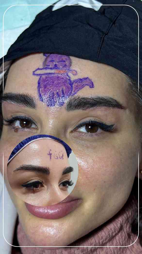 لیفت شقیقه و گونه 8 دو هفته بعد از لیفت تحتانی