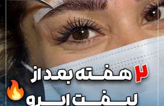 دو هفته بعد از دایرکت ابرو