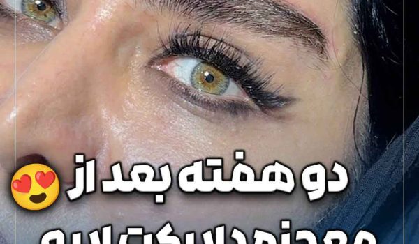 دو هفته بعد از معجزه دایرکت ابرو