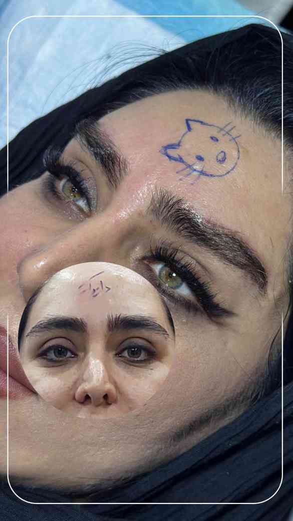 دو هفته بعد از جراحی لیفت ابرو