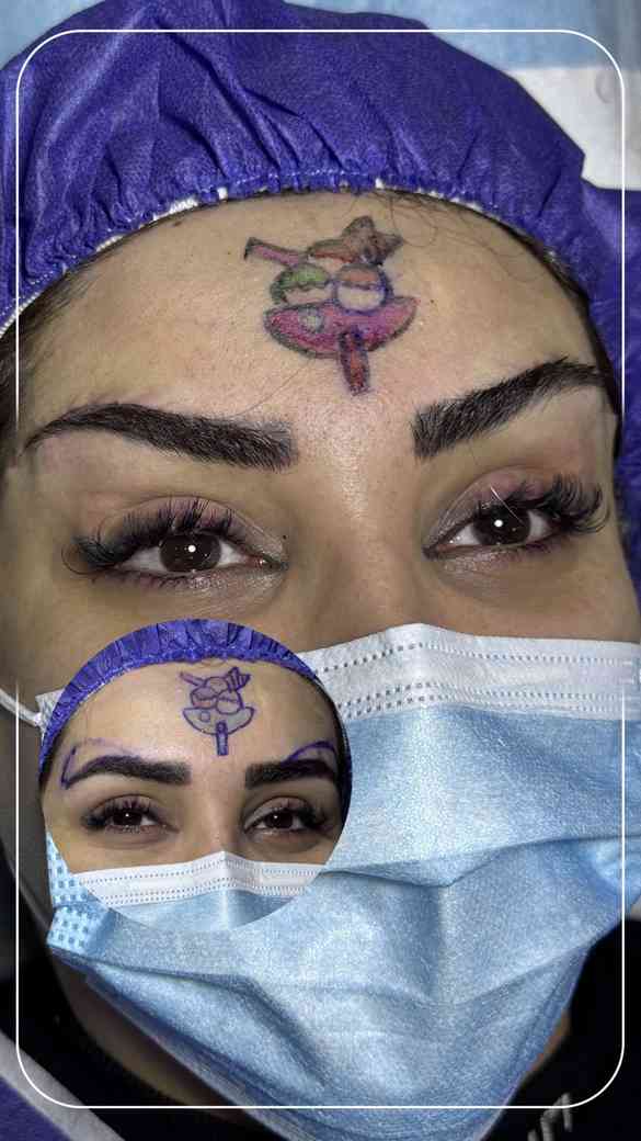 بلافاصله بعد از لیفت دایرکت