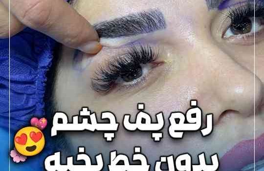 رفع پف چشم بدون خط بخیه