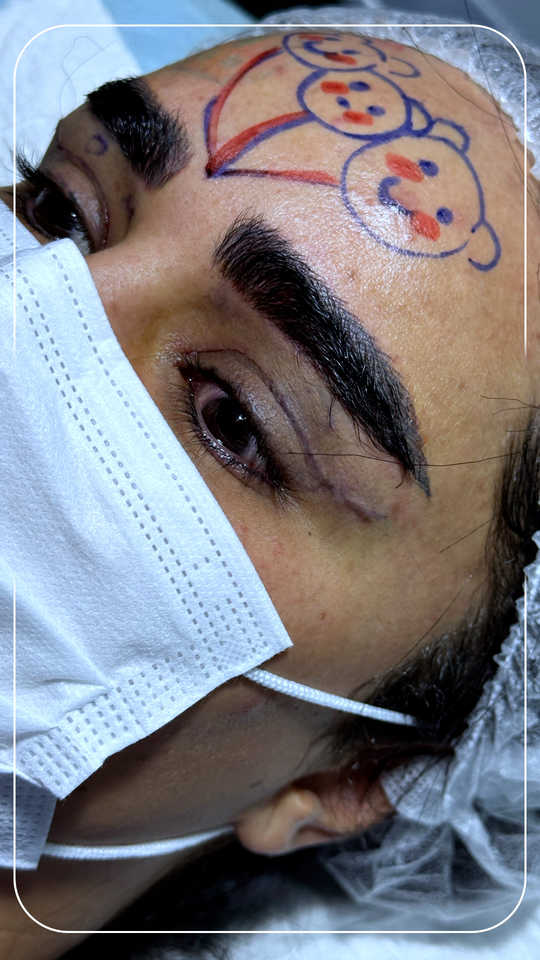 بلفاروپلاستی 5 ظرافت بخیه ها پس از جراحی بلفاروپلاستی