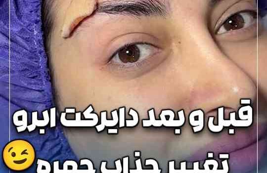قبل و بعد دایرکت ابرو تغییر جذاب چهره