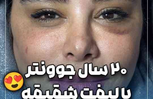 لیفت شقیقه و گونه آندوسکوپیک
