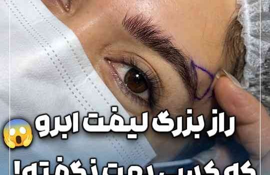 مهم ترین راز لیفت شقیقه