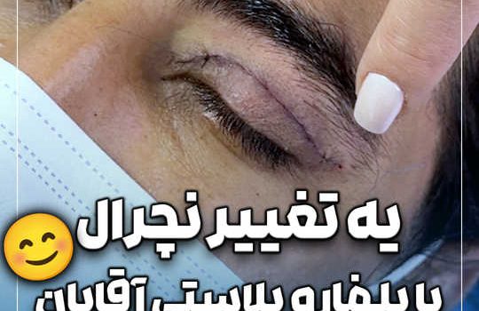 یه تغییر نچرال با بلفاروپلاستی آقایان