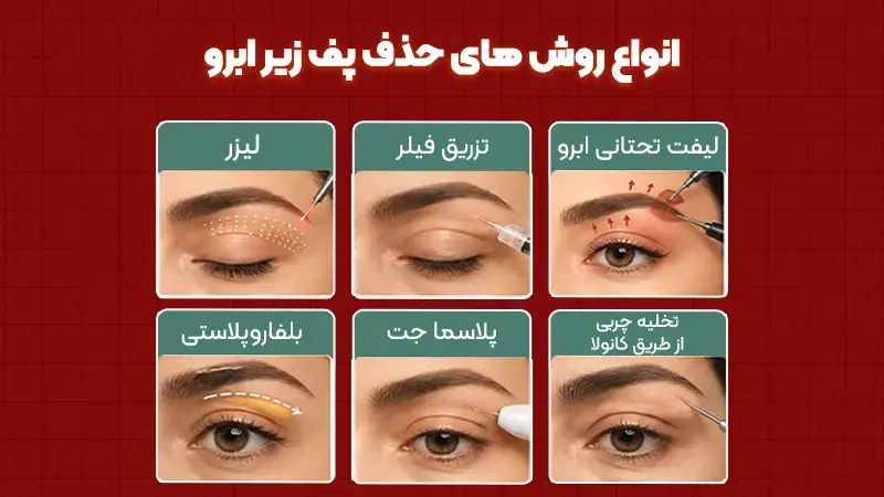 لیفت تحتانی ابرو چیست و چه تفاوتی با سایر روشها دارد؟ 3 انواع روشهای حذف پف زیر ابرو