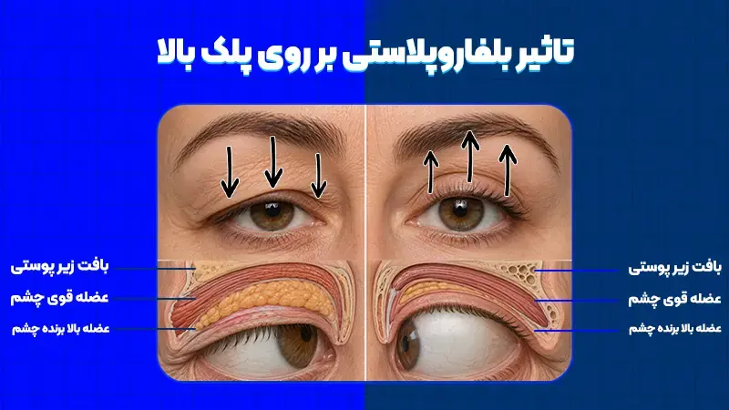 بلفاروپلاستی پلک بالا چیست و چه تفاوتی با سایر روشها دارد؟ 1 بلفاروپلاستی پلک بالا چیست؟