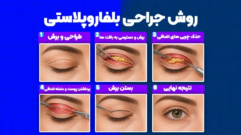 بلفاروپلاستی پلک بالا چیست؟ بررسی کامل روش، مزایا، عوارض و هزینه 3 روش انجام بلفاروپلاستی پلک بالا