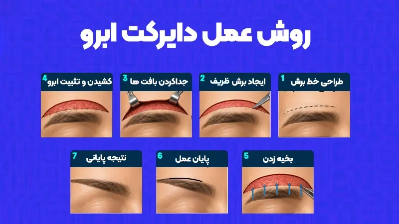 دایرکت ابرو چیست؟ بررسی کامل روش، مزایا، عوارض و هزینه 3 چگونگی روش دایرکت ابرو