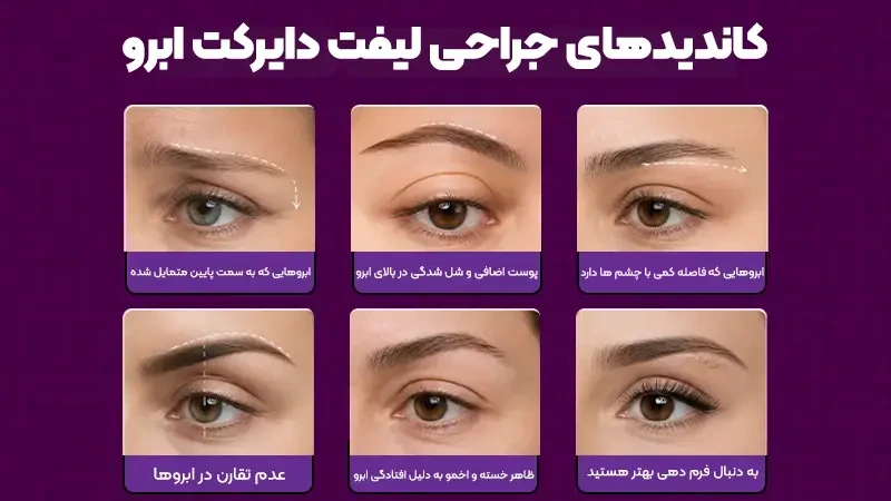 راهنمای جامع کاندیدهای دایرکت ابرو؛ از آمادگی تا بهبودی 2 لیفت دایرکت ابرو چیست؟