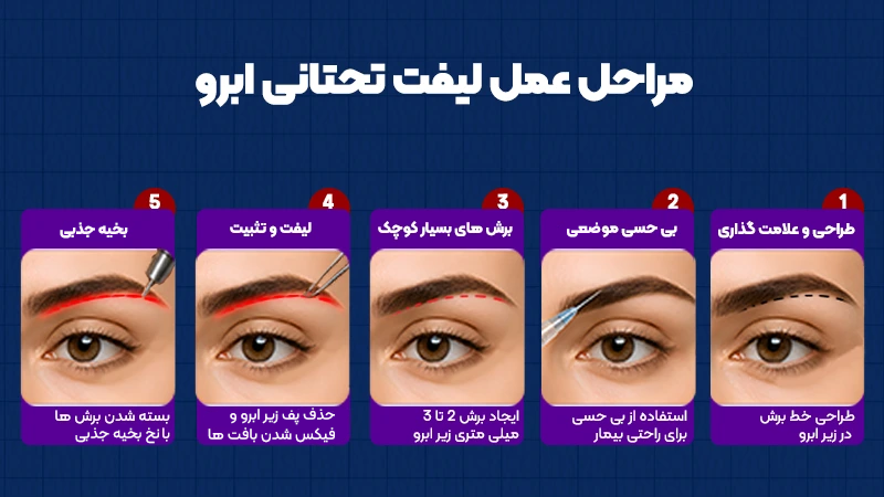 همه چیز درباره لیفت تحتانی ابرو؛ از نحوه انجام تا نتایج و مراقبتها 1 نحوه انجام لیفت تحتانی ابرو