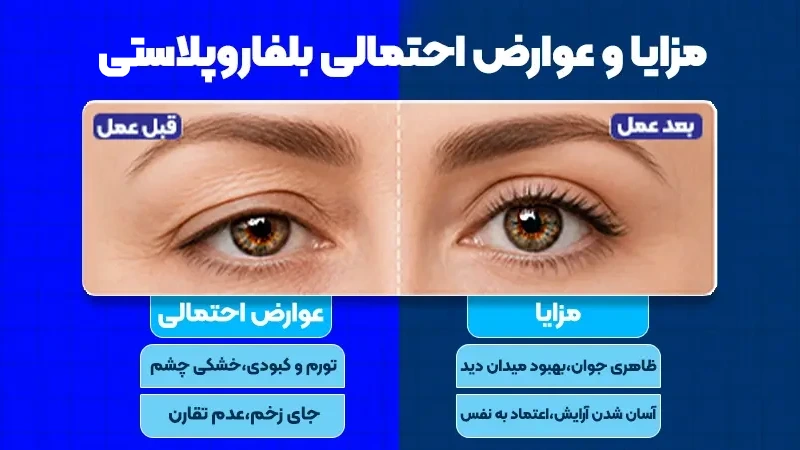 بلفاروپلاستی پلک بالا چیست؟ بررسی کامل روش، مزایا، عوارض و هزینه 2 مزایا بلفاروپلاستی پلک بالا