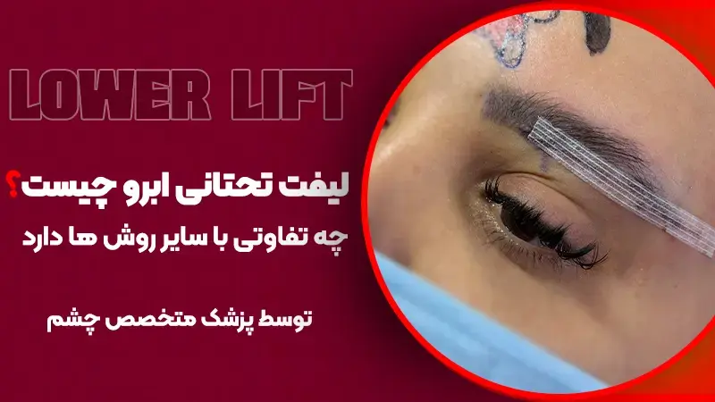 لیفت تحتانی ابرو چیست و چه تفاوتی با سایر روشها دارد؟