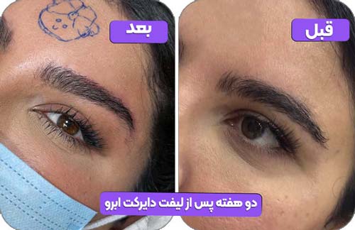 صفحه اصلی 35 2 هفته پس از لیفت دایرکت ابرو