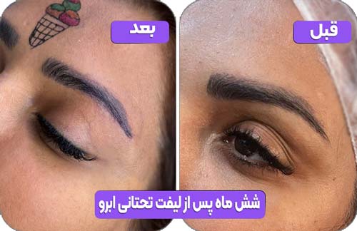 لیفت تحتانی ابرو 40 شش ماه پس از لیفت تحتانی ابرو