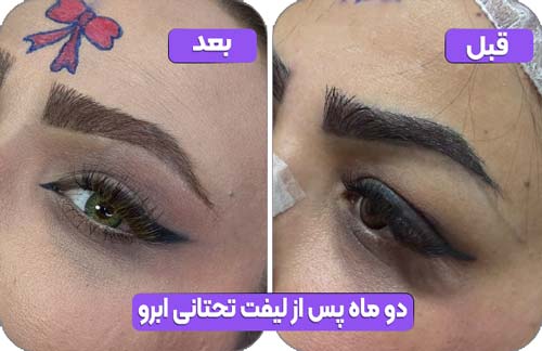 لیفت تحتانی ابرو 39 دو ماه پس از لیفت تحتانی ابرو