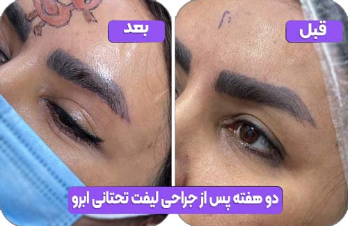 لیفت تحتانی ابرو 37 دو هفته پس از جراحی لیفت تحتانی ابرو