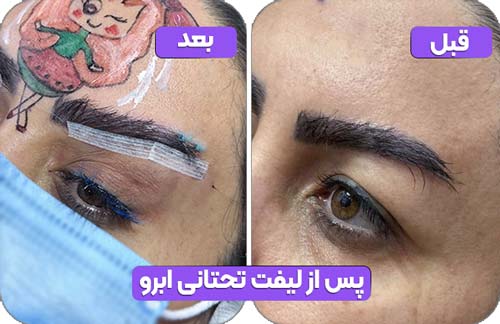 لیفت تحتانی ابرو 38 پس از لیفت تحتانی ابرو