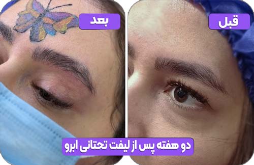 لیفت تحتانی ابرو 36 دو هفته پس از لیفت تحتانی ابرو