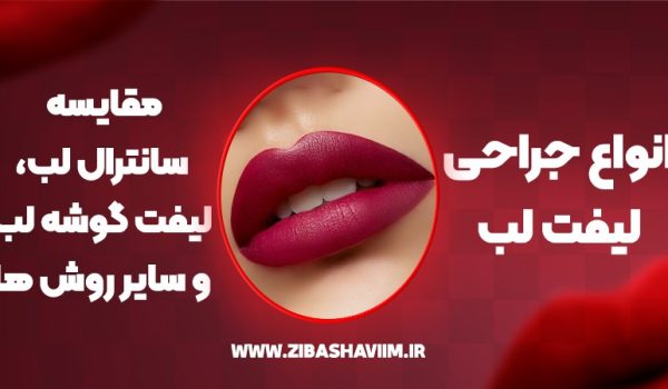 انواع جراحی لیفت لب؛ مقایسه سانترال لب، لیفت گوشه لب و سایر روش‌‌ها