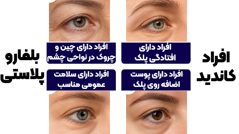 بلفاروپلاستی یا لیفت تحتانی ابرو؟ کدام روش زیبایی برای شما مناسبتر است؟ 2 کاندیدها+ مزایا بلفاروپلاستی