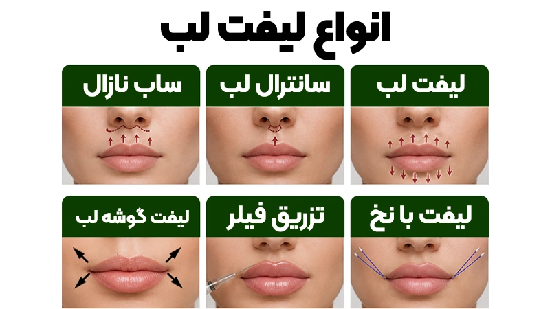 لیفت لب چیست؟ بررسی شرایط، مزایا و هر آنچه باید بدانید 2 انواع روشهای لیفت لب