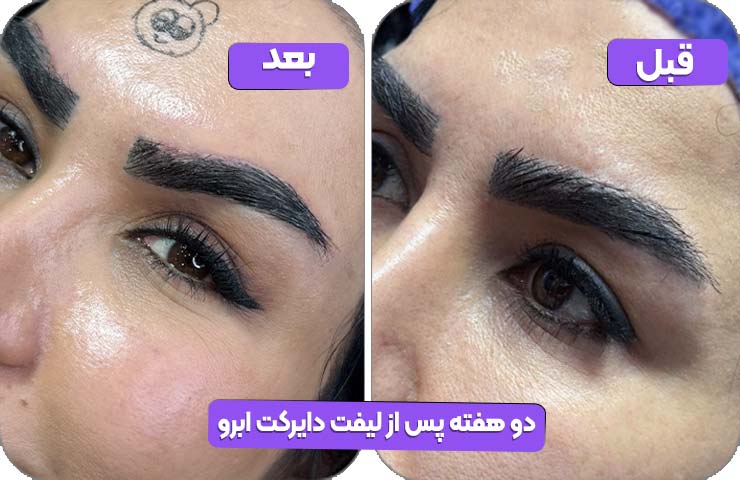 دو هفته پس از لیفت دایرکت ابرو