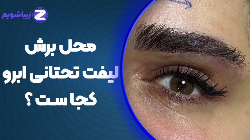 محل برش لیفت تحتانی ابرو کجاست؟