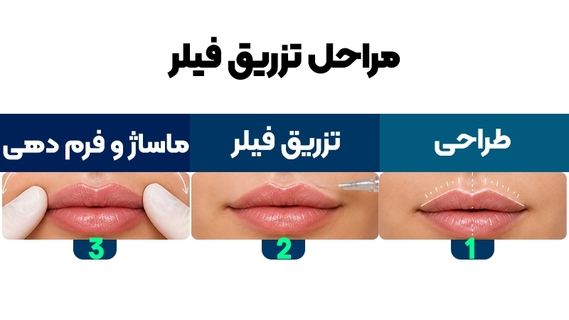 لیفت لب یا تزریق فیلر؛ کدام یک برای شما مناسب است؟ 3 چگونگی انجام فیلر لب