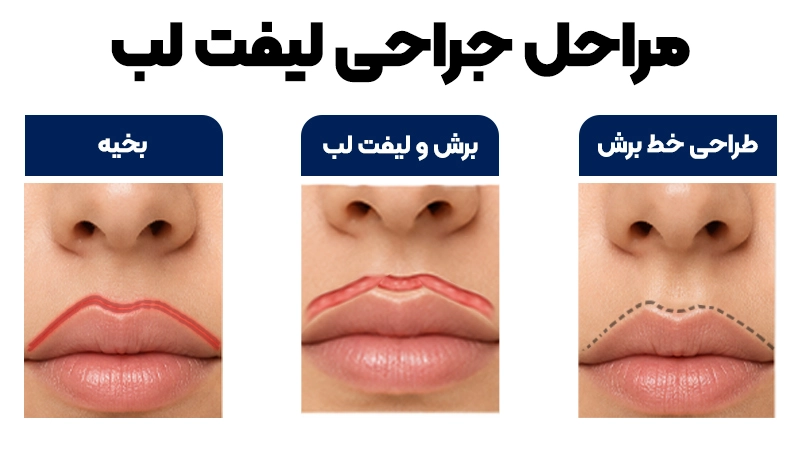 لیفت لب یا تزریق فیلر؛ کدام یک برای شما مناسب است؟ 2 چگونگی لیفت لب