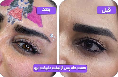 هفت ماه پس از لیفت دایرکت ابرو