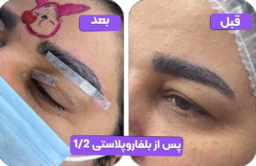 بلفاروپلاستی 37 پس از بلفاروپلاستی 1.2