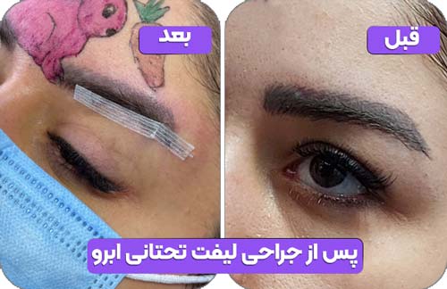 صفحه اصلی 36 پس از جراحی لیفت تحتانی ابرو