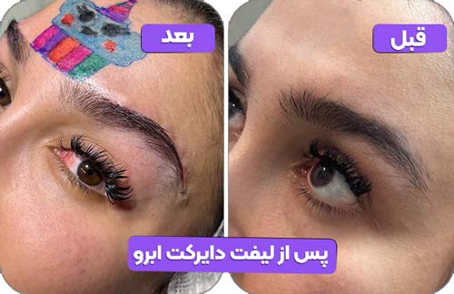 پس از لیفت دایرکت ابرو 1
