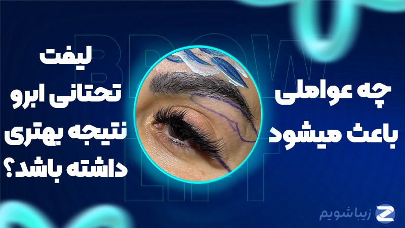 چه عواملی باعث می‌شوند؛ لیفت تحتانی ابرو نتیجه‌ای بهتر داشته باشد؟