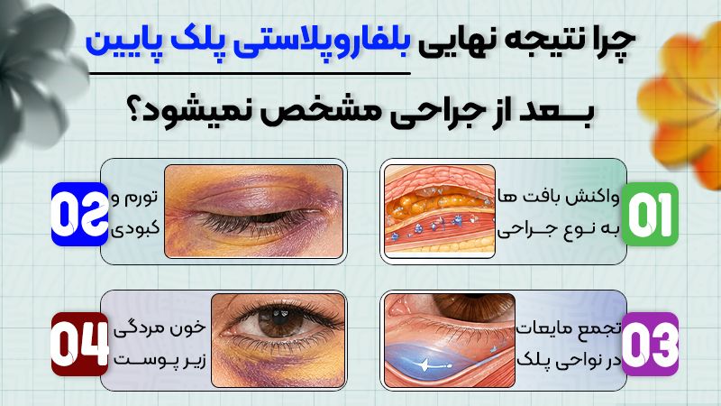چه زمانی نتیجه نهایی بلفاروپلاستی پلک پایین مشخص میشود 1 چرا نتیجه نهایی بلفاروپلاستی پلک پایین، بعد از جراحی مشخص نمیشود؟