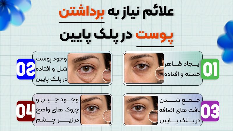 چه زمانی بلفاروپلاستی پلک پایین به برداشتن پوست نیاز دارد؟ 1 علائم نیاز به برداشتن پوست در پلک پایین