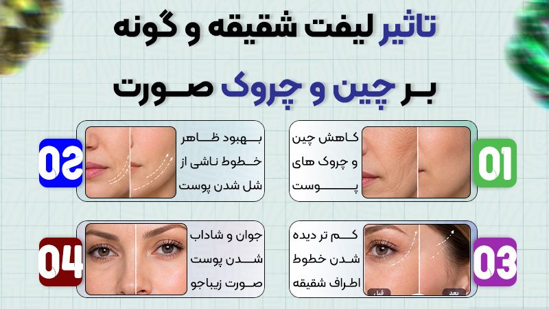 تاثیر لیفت شقیقه و گونه بر روی چهره 2 تاثیر لیفت شقیقه و گونه بر چین و چروک صورت