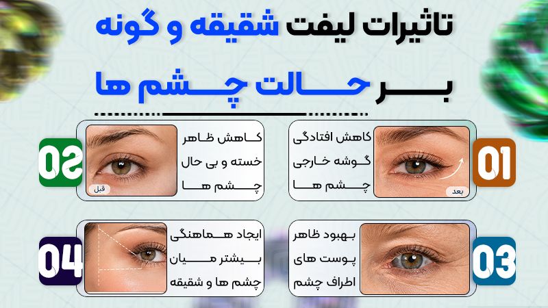 تغییرات ایجاد شده در چهره با لیفت شقیقه و گونه 1 تاثیر لیفت شقیقه و گونه بر حالت چشمها