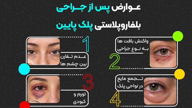 چه زمانی نتیجه نهایی بلفاروپلاستی پلک پایین مشخص میشود 2 عوامل تاثیرگذار در نتیجه بلفاروپلاستی پلک پایین