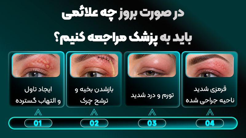 خارش محل بخیه بعد از لیفت تحتانی ابرو طبیعی است؟ 1 چرا محل بخیه بعد از لیفت تحتانی ابرو دچار خارش میشود؟
